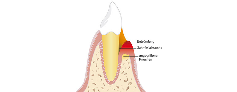 Zahnfleischentzündung? Zahnarzt Bielefeld bei Parodontose