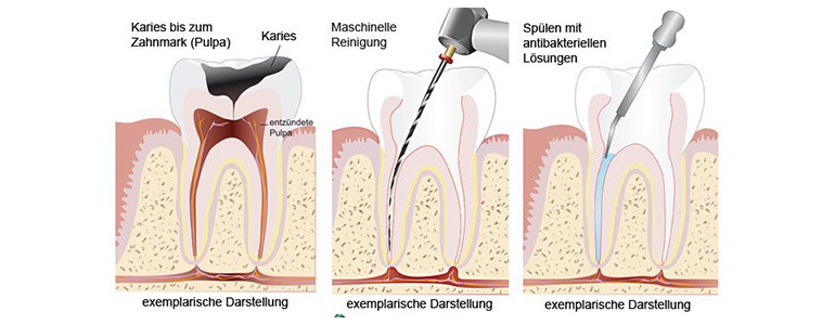 Wurzelkanalbehandlung in Bielefeld für Zahnerhalt
